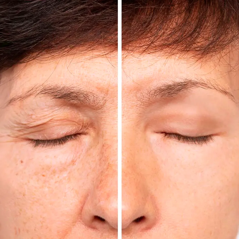 Imagem ilustrativa de Blefaroplastia