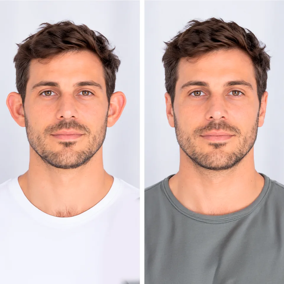 Imagem ilustrativa de Otoplastia